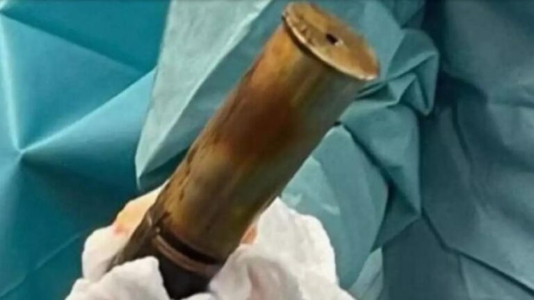 BALANUKU – Hospital aciona esquadrão antibombas após jovem dar entrada com projétil de 20 cm no ânus